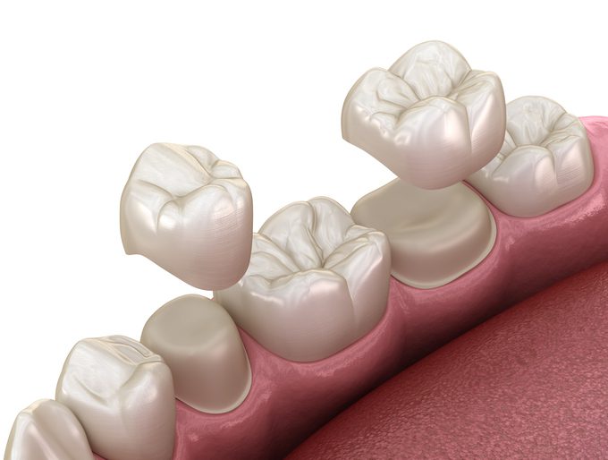 dental crown treatment in tyler, texas