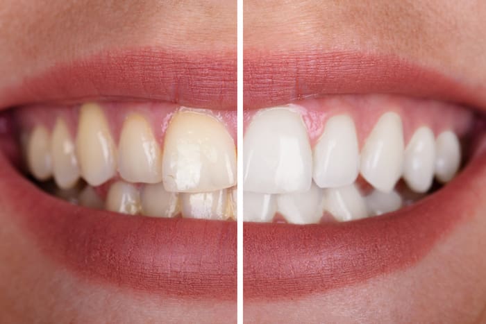 teeth whitening treatment in tyler, texas