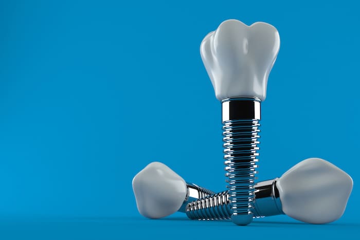 dental implant procedure in tyler, texas