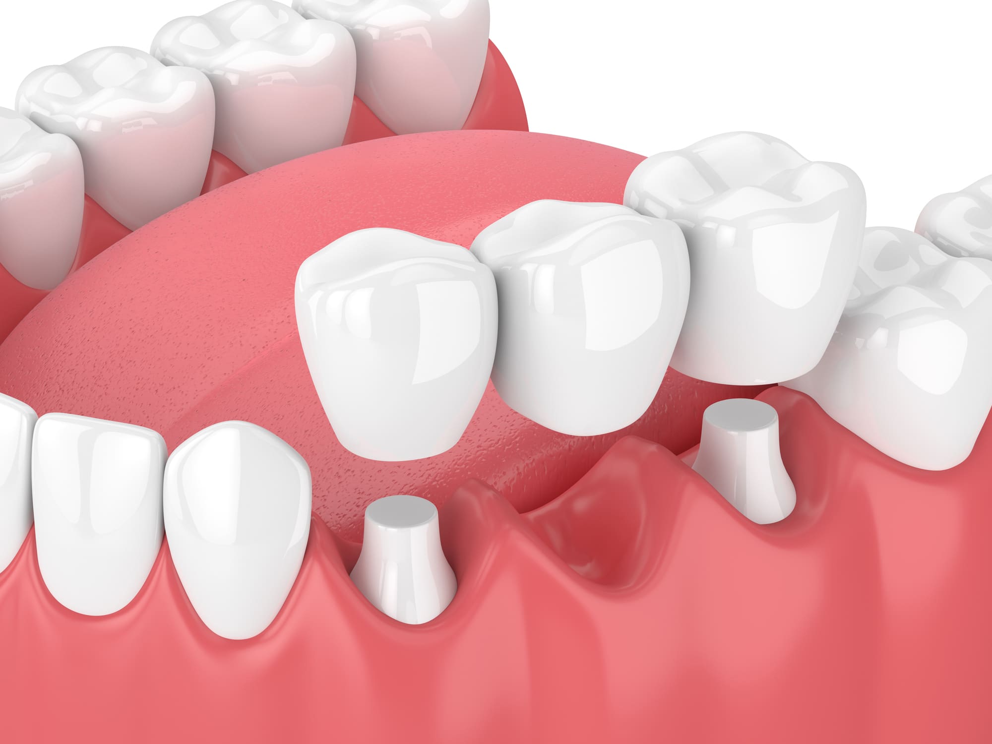 dental bridge treatment in tyler, texas