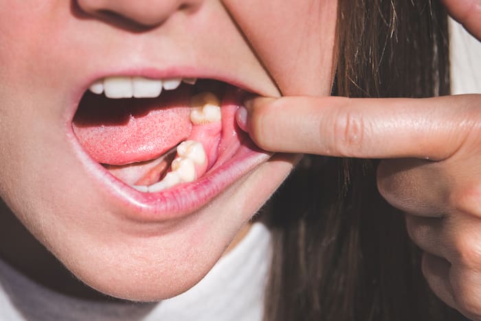 tooth extraction in tyler, texas